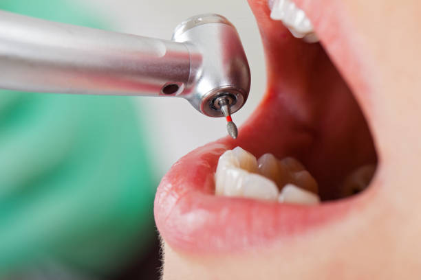Best Emergency Root Canal Treatment in Eslon, CA